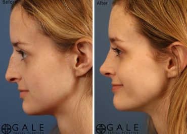 Reshape and Rejuvenate with Rhinoplasty Washington DC